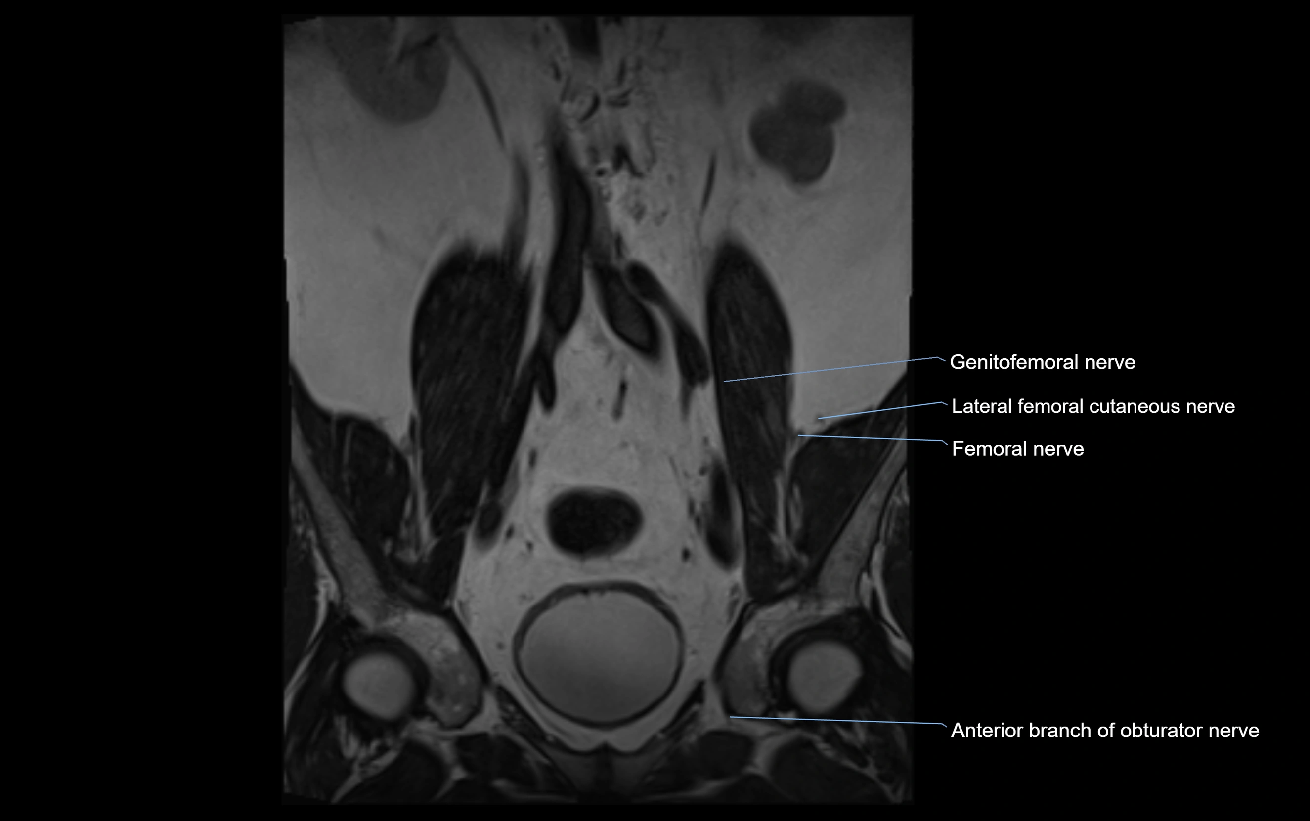 MR lumbosacral plexus cross sectional anatomy 3T  radiology  image-img-09001-00009.webp